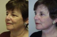 65-74 year old woman treated with Facelift