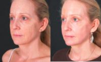 45-54 year old woman treated with Chemical Peel