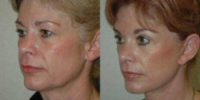 55-64 year old woman treated with Facelift