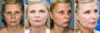 facelift, fat grafts to lower eyelids, chin implant