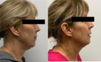 55-64 year old woman treated with FaceTite