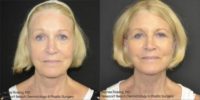 76 year old woman treated with a Facelift