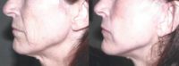 55-64 year old woman treated with Mini Facelift