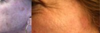 45-54 year old woman treated with Alexandrite Laser for Age & Sun Spots