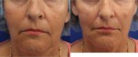 64 year old woman treated with Bellafill for mid face volume loss