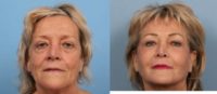 CO2 Laser to the full face for Wrinkles and Sun Damage