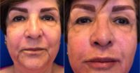 65-74 year old woman treated with Radiesse and Voluma for non-surgical lower face lift