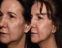 Non Surgical Face Lift