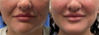 18-24 year old woman treated with Juvederm, Lip Fillers