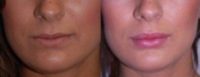 Juvederm to Lips