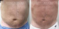 55-64 year old man treated with SculpSure