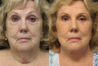 55-64 year old woman treated with Facelift