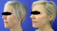 55-64 year old woman treated with CO2 Laser, Smartlipo, Filler and Xeomin