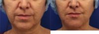 48 year old woman treated with Sculptra