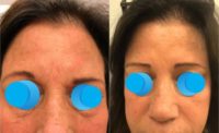 45-54 year old female reated with Botox for eyebrow asymmetry