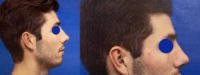 24 year old man treated with Rhinoplasty