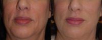 Juvederm to Nasolabial folds and Oral Commissures