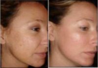 Woman treated for Melasma with Fraxel Laser