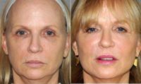 Non Surgical Face Lift