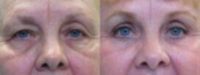 Eyelid Surgery