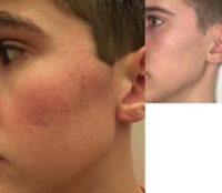 17 or under year old man treated with Microneedling