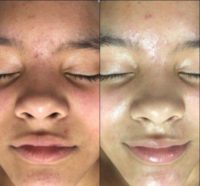 17 or under year old woman treated with Facial