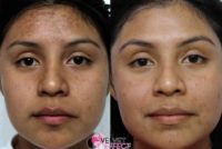18-24 year old woman treated with Vi Peel