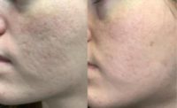 25-34 year old woman treated with SkinPen