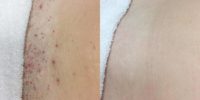 25-34 year old man treated with Laser Hair Removal