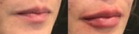 25-34 year old woman treated with Dermal Fillers for Lip Augmentation
