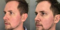 25-34 year old man treated with Microneedling for Redness