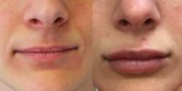 25-34 year old woman treated with Lip Augmentation for Wedding