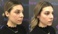 25-34 year old woman treated with Chin Fillers