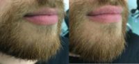 35-44 year old man treated with Lip Augmentation