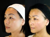 35-44 year old woman treated with Nonsurgical Facelift,