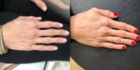 35-44 year old woman, dorsal Hand filler