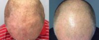 45-54 year old man treated with PRP for Hair Loss