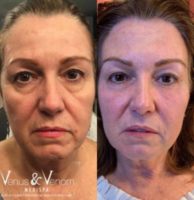 45-54 year old woman treated with Restylane