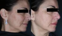 45-54 year old woman treated with Halo Laser