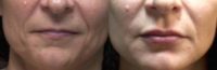 45-54 year old woman treated with Injectable Fillers for the lips and lower face