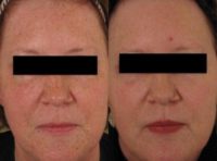 51 year old woman treated with PicoSure