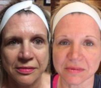 45-54 year old woman treated with Vampire Facelift