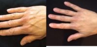 45-54 year old woman treated with Hand Rejuvenation