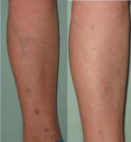 55-64 year old woman treated with Sclerotherapy