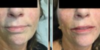 55-64 year old woman treated with Volbella