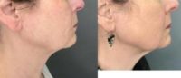 65-74 year old woman treated with Skin Tightening