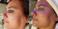 65-74 year old woman treated with HydraFacial