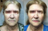65-74 year old woman treated with Cheek Augmentation