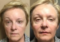 65-74 year old woman treated with Injectable Fillers (Voluma, Juvederm, Belotero)