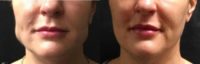 45-54 year old woman treated with Botox for TMJ